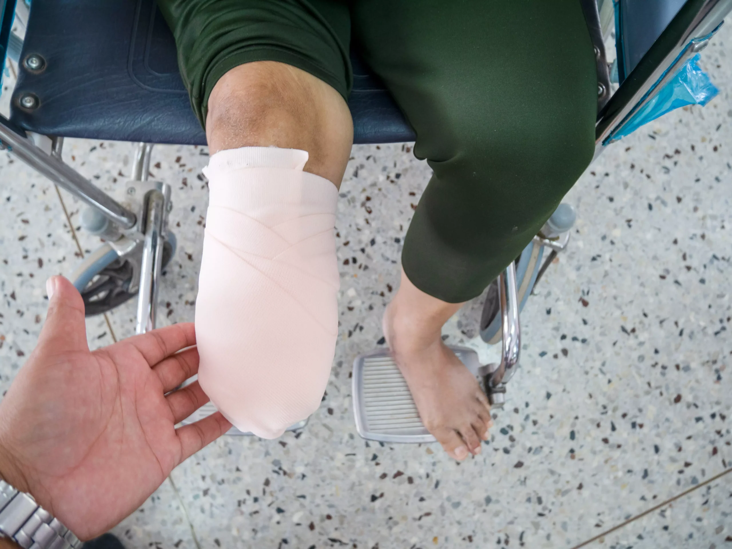 amputated leg